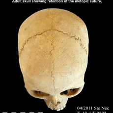 Adult skull showing retencion of the metopic suture