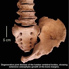 Degenerative joint disease of the lumbar vertebral bodies